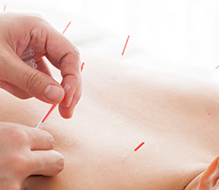 acupuncture_12