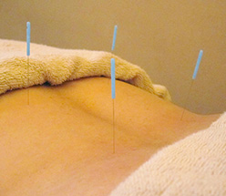 acupuncture_15